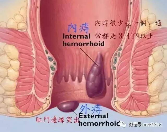 痔疮患者应该了解的这些知识