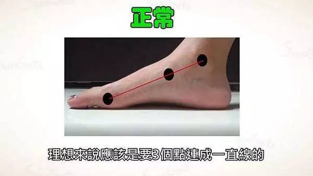 高足弓:中间的点在连线上方