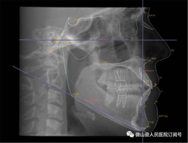 颞下颌关节(tmj)摄影:包括tmj开口/闭口侧位片,tmj开口/闭口正位片.