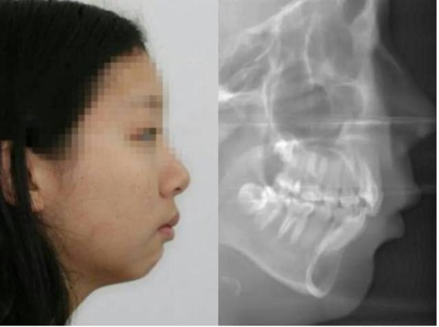 骨性Ⅲ类示例,地包天,下颌骨发育过度,上颌骨发育不足.
