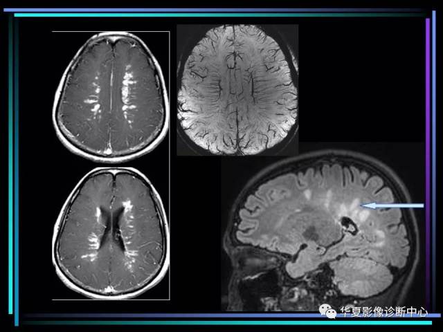 多发性硬化影像学诊断(简版)