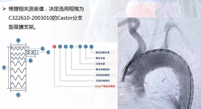 【病例分享】运用castor 分支型主动脉覆膜支架系统治疗胸主动脉溃疡