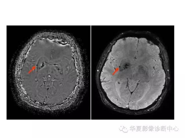 腔梗,脑白质病变,vr间隙扩大,看完这篇不再迷茫