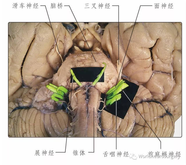 彩图经典版 | 脑神经和脑神经核解剖 atlas