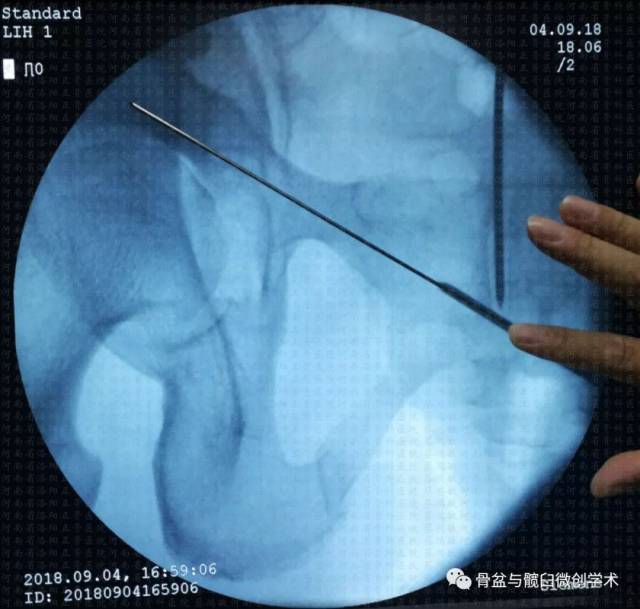 改良经皮逆行耻骨上支或髋臼前柱髓内螺钉置入技术及其应用示例