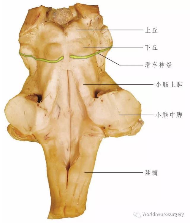 7)走向背侧,绕过中脑水管周围灰质,在中线交叉后,自下丘尾侧的脑干背