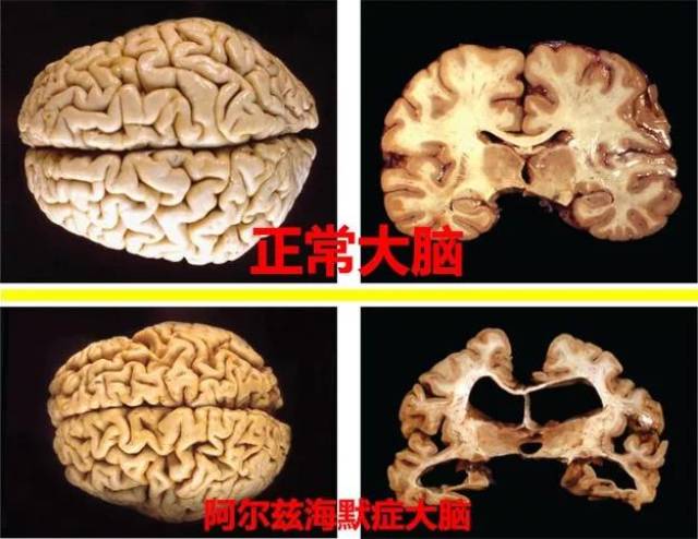 6大支柱预防阿尔兹海默症