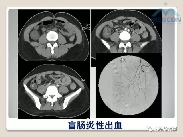 隐匿性消化道出血影像学诊断 | 影像天地