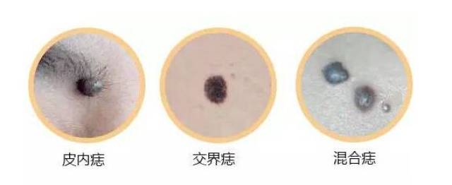【健康】身上的这种小黑痣会癌变,别轻视!