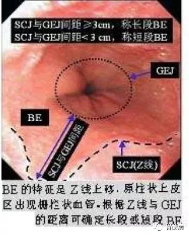 巴雷特食管(barrett)的分类与诊疗