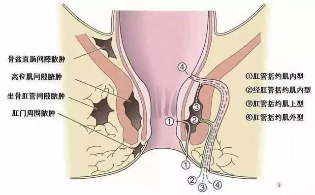 由脓肿引起的肛瘘应注意这7点