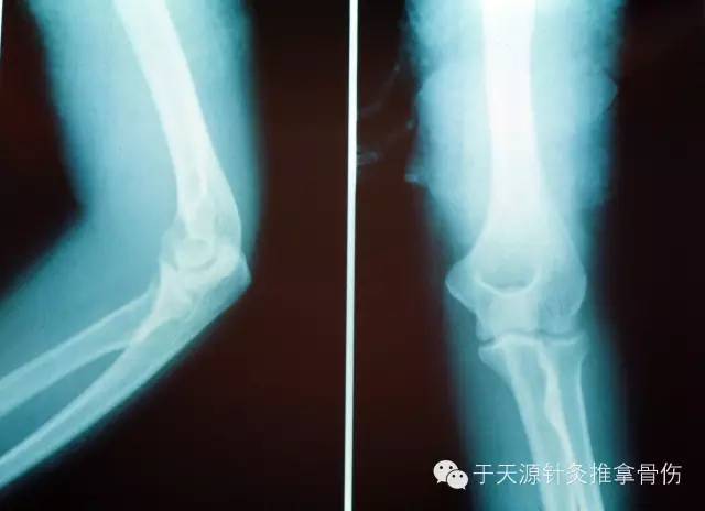 《听故事学推拿025》成人桡骨头半脱位的病例