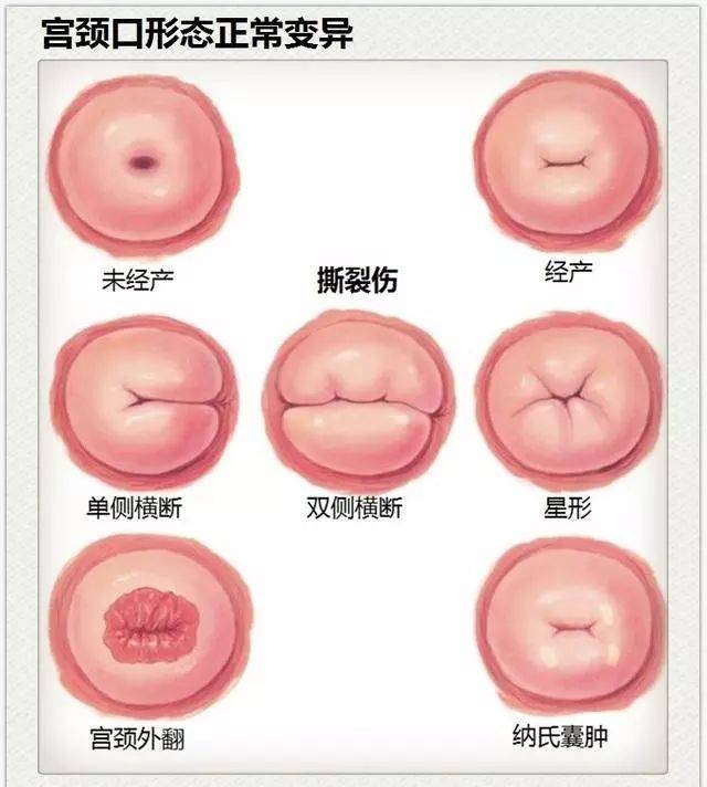 2,碘试验 正常宫颈,阴道上皮含有丰富的糖原,可被碘液染成棕色或深赤