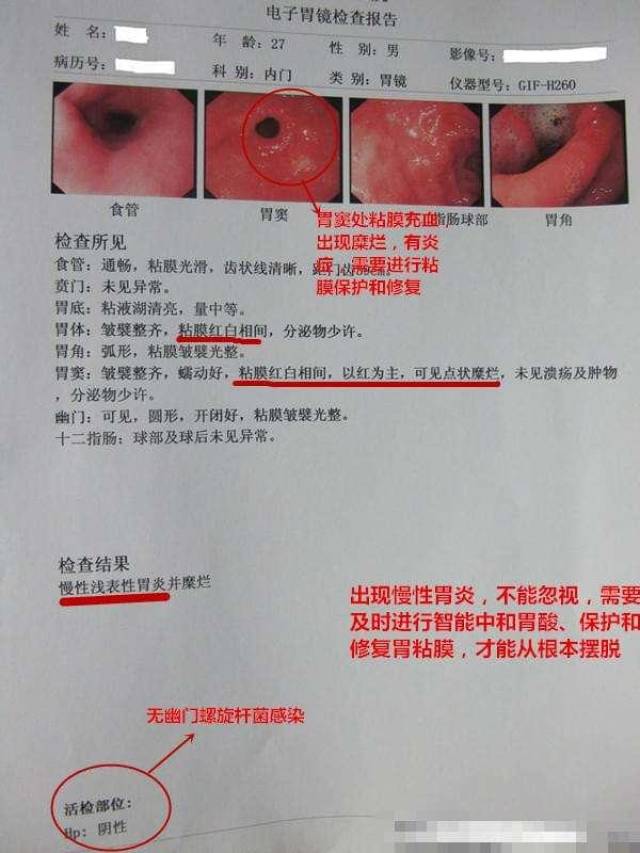 急性胃炎发病原因