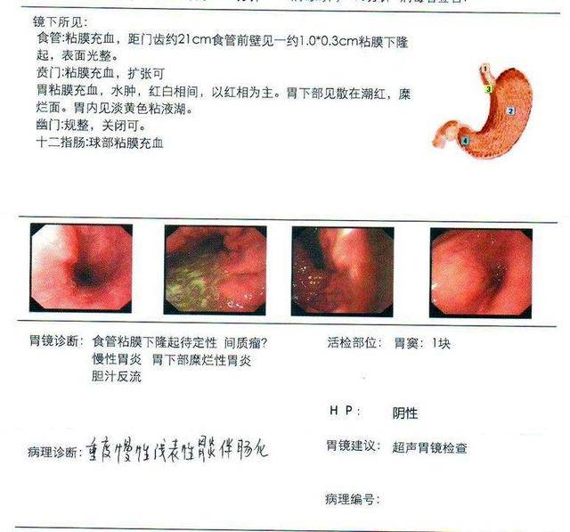 急慢性胃炎的常见临床症状