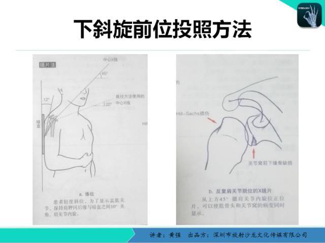 肩关节脱位影像诊断