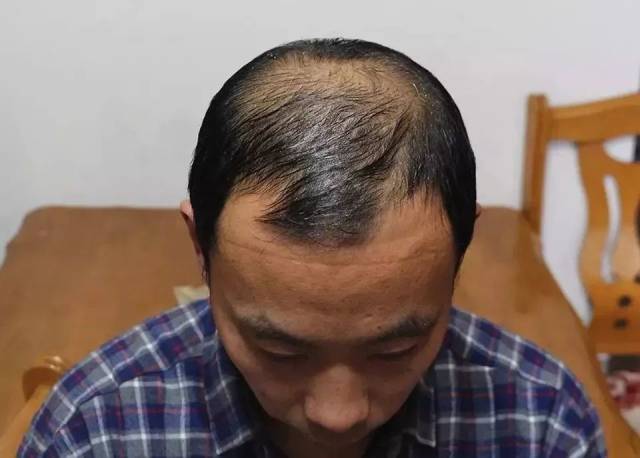 每天掉多少根头发算正常?头发大把掉,脱发、秃