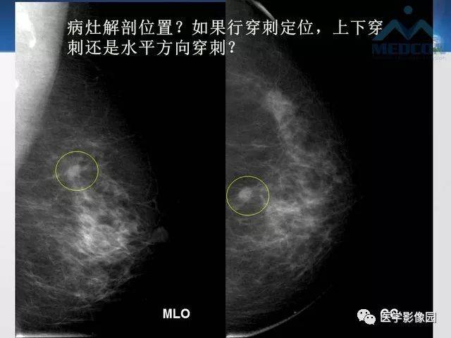 专家手把手教您x线摄影如何对乳腺病灶精确定位 影像天地