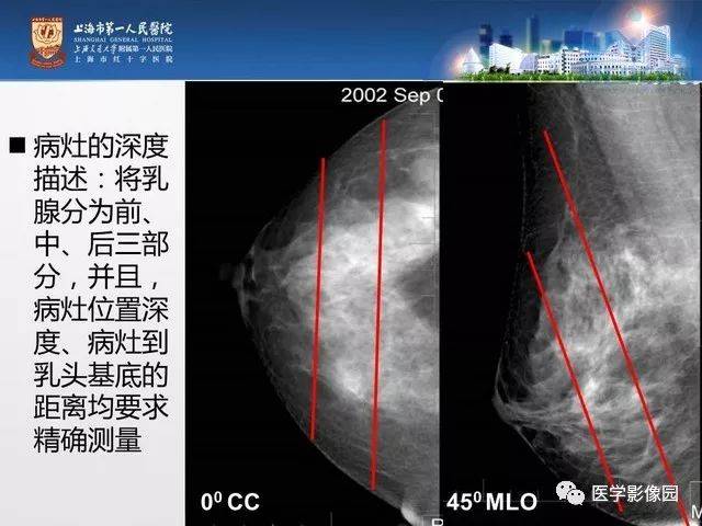 专家手把手教您x线摄影如何对乳腺病灶精确定位 影像天地