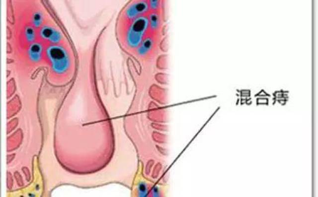 混合痔,也称内外痔,是以发生于肛门同一方位齿线上下,静脉曲张形成
