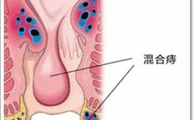 在肛肠疾病中混合痔是痔疮中比较严重的一种,是内痔和外痔的混合体.