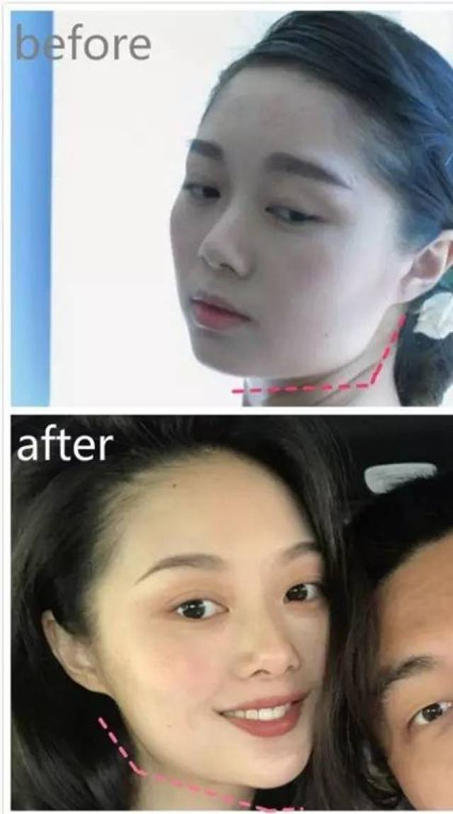 加上垫了下巴,又进一步的使脸拉长,虽然还是方形脸,但是气质却是直线