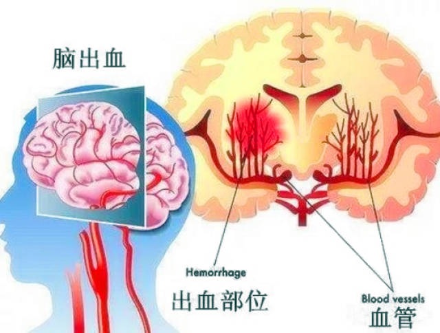 高血压性脑出血如何救治?