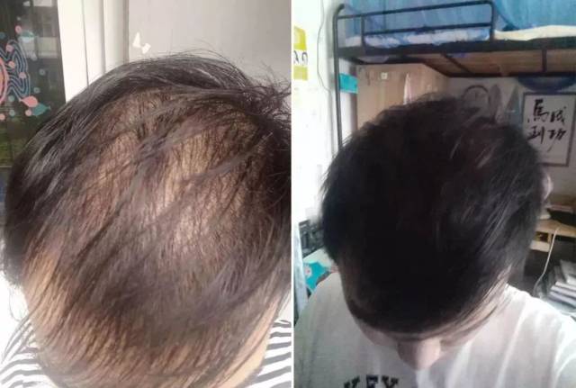 每天掉多少根头发算正常?头发大把掉,脱发、秃