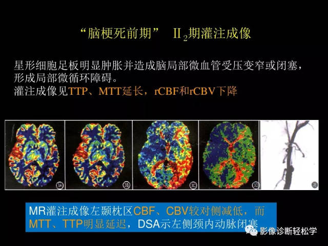 缺血性脑血管病的CT、MR灌注成像