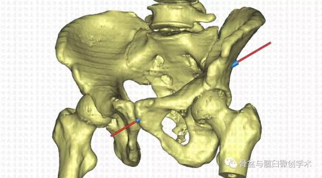 髋臼横形骨折的微创治疗:经皮前柱 后柱螺钉置入手术