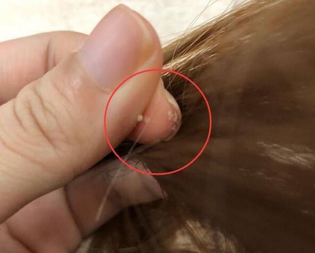 2,洗完头仍有白色粉屑:螨虫啃食头皮细胞,细胞死亡会产生细密的粉屑.