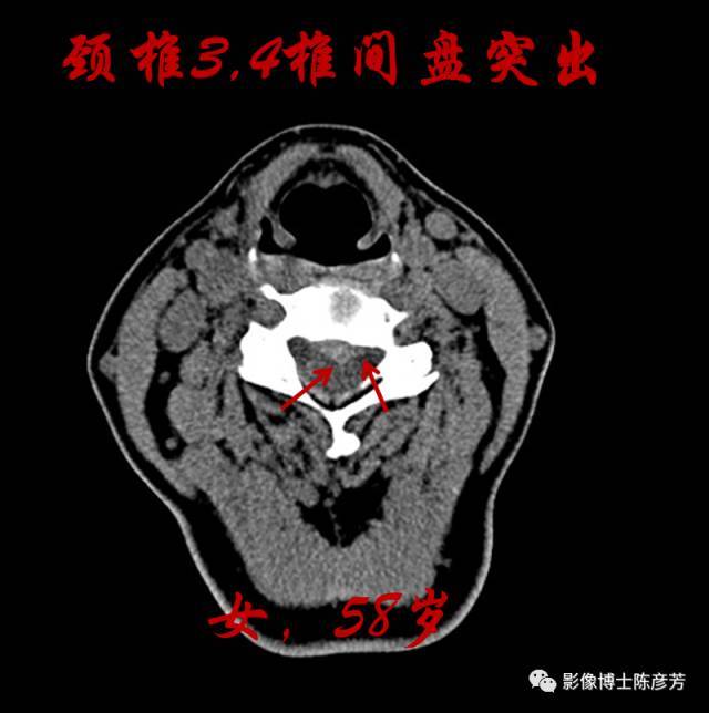 颈椎间盘ct显示: 骨窗显示椎体骨质增生,右侧钩椎关节骨质增生,间隙不