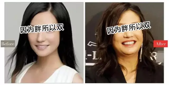 ▽ 双下巴形成及治疗方案 1 如图所示,当颈部脂肪堆积 过度脂肪沉积