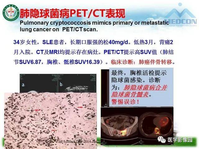 多样肺隐球菌病影像面面观 影像天地