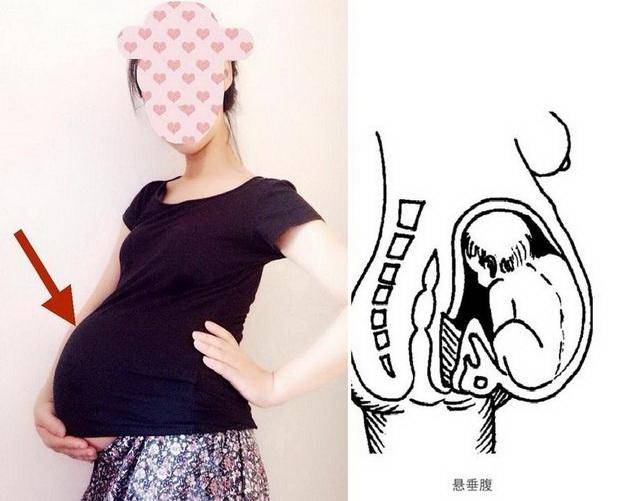又称 妊娠子宫过度前屈,也就是肚子全在前面,而且是垂下去的,后腰