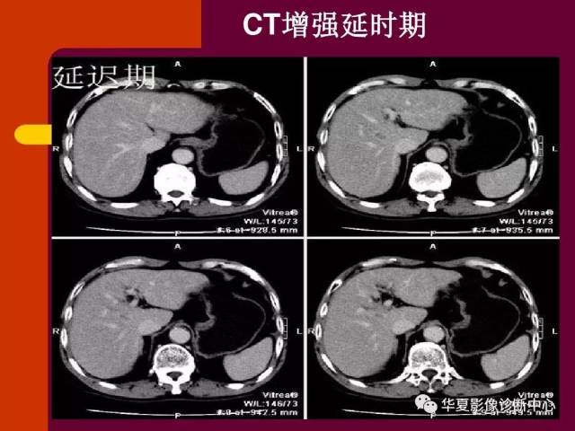 【影像基础】快来看,五花八门的小肝癌ct表现!