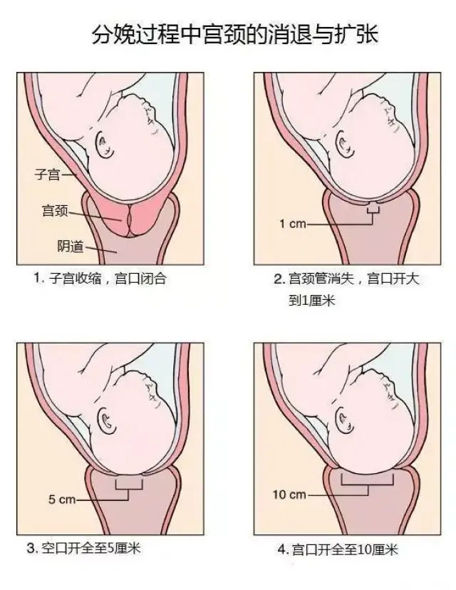 临近分娩,由于不规律的子宫收缩牵动宫颈,使得宫颈内口附近的胎膜和