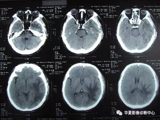 【影像基础】脑脓肿分期和ct表现