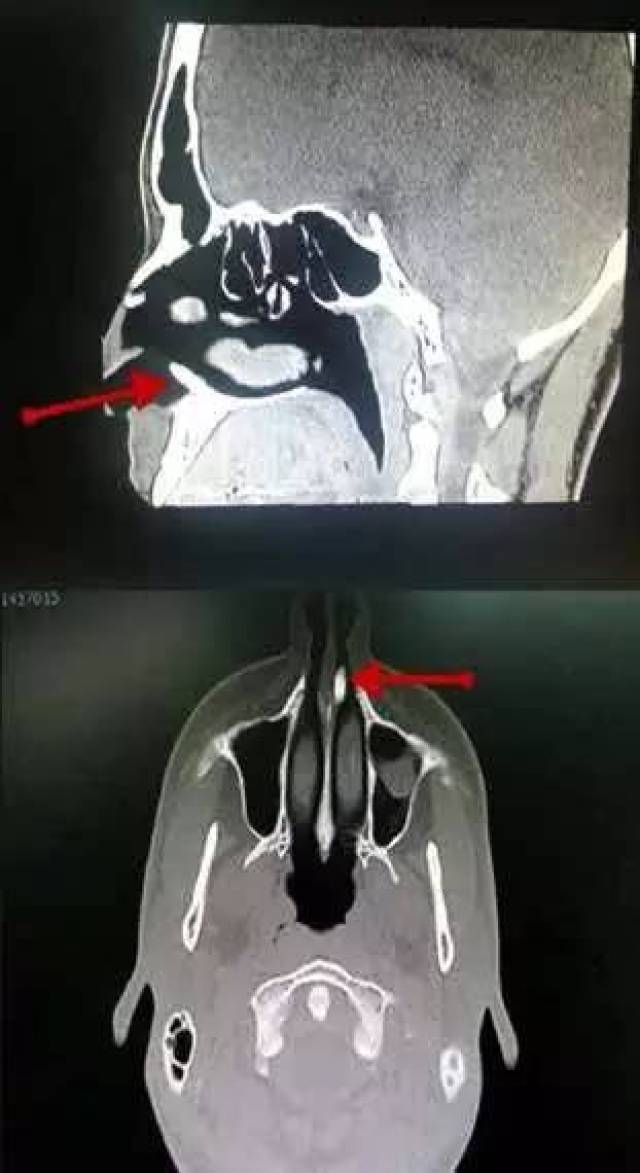 镜检查示乳白色圆柱状骨质肿块,长度为 1 cm,由鼻腔底侧长出,与鼻中隔