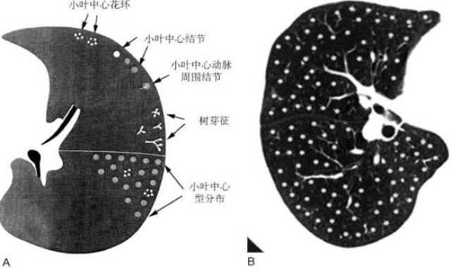 小叶中心型结节