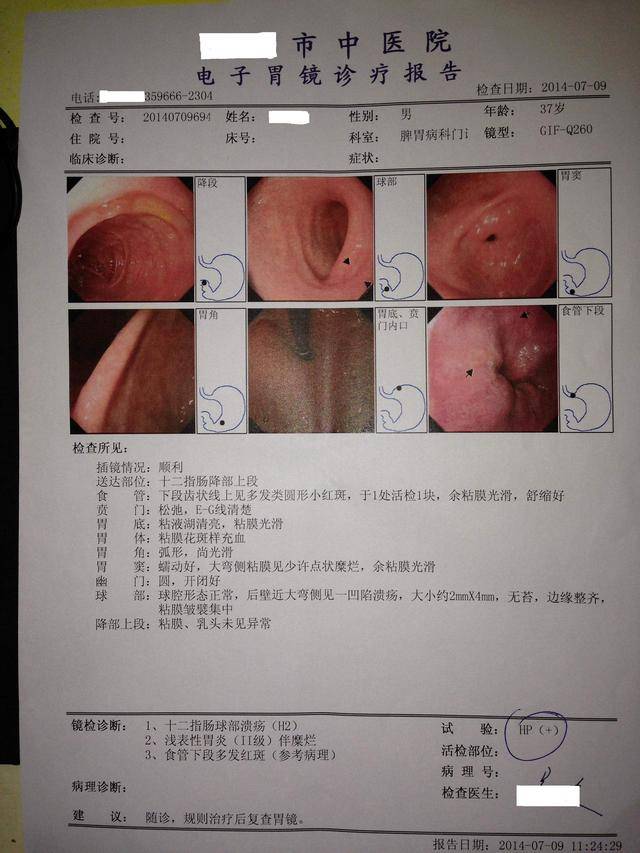引起食管炎的病因和临床表现!