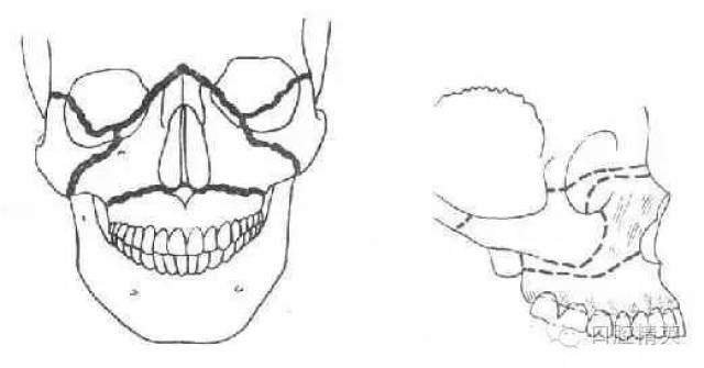 第一型骨折(lefort Ⅰ型骨折)其骨折线通过梨状孔下缘,上颌窦下部