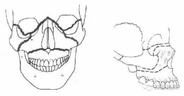 颌骨骨折