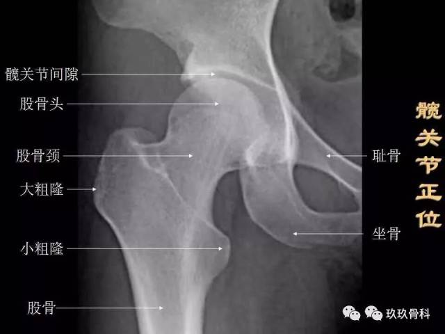 髋关节x线解剖 摄影技术 测量方法