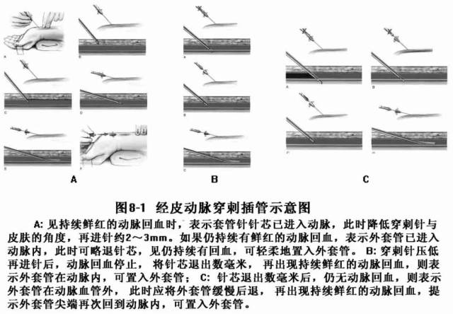 在动脉旁皮内与皮下注射局麻药或全麻诱导后用20g留置针进行桡动脉