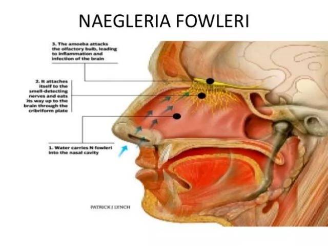 在偶然的机率下,将病原体吸入鼻腔,福氏耐格里变形虫沿着嗅觉神经