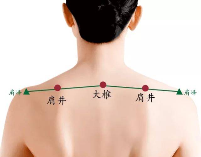 位置:肩井穴位于后项部第7颈椎与肩峰之间的中点,在肩部最高处,左右各