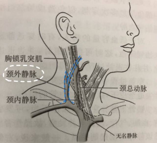 这个部位的留置针,千万别久留!