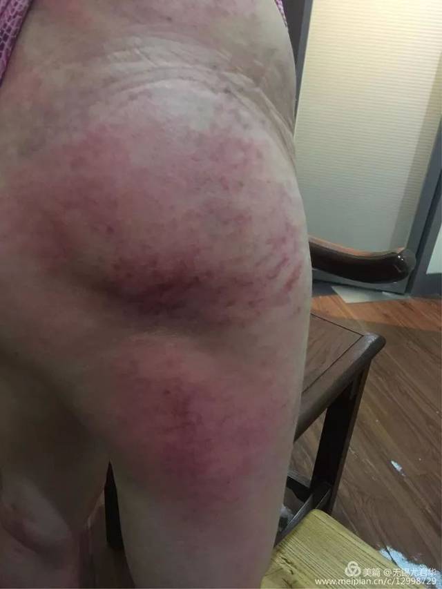 上图是第一次刮痧后患处痧像,可以看得出坏死关节处肌肉因为气血不至