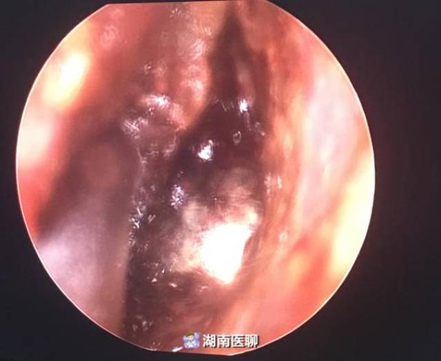 检查发现,电池崁顿在孩子鼻道中后段,已引起 严重的局部水肿和腐蚀
